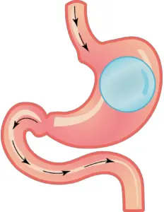 Tratamiento de cirugia bariatrica tipo Balon Allurion