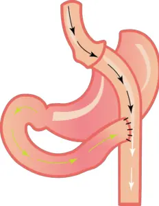 Tratamiento de cirugia bariatrica tipo ByPass clásico